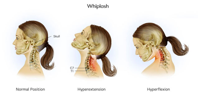whiplash Neck Physiotherapy